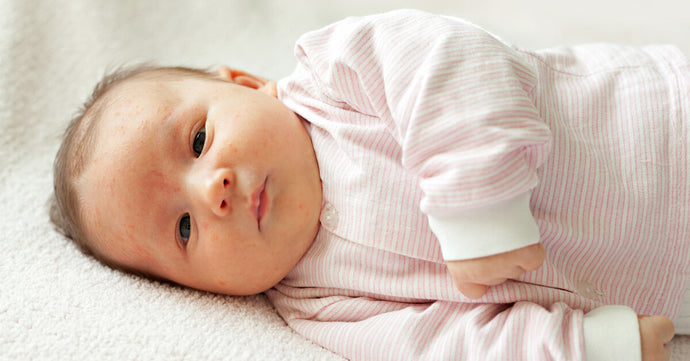 Baby Acne Basics: Caring For Your Newborn’s Skin