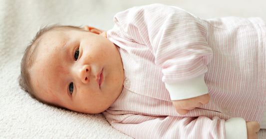 Baby Acne Basics
